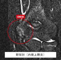 肘関節MRI