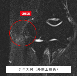 肘関節MRI