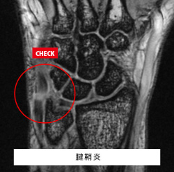 腱鞘炎