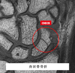 舟状骨骨折