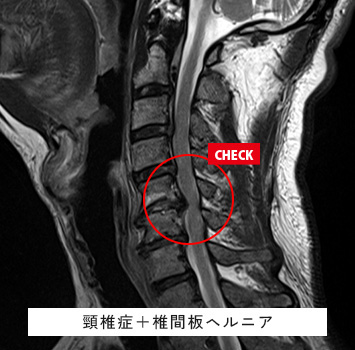 首の痛み、手のしびれ