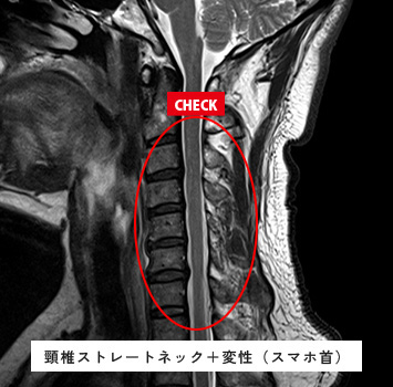 慢性的な首のだるさ、こり