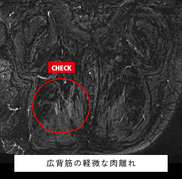 特に誘因なく背部痛が続く、レントゲンやCTで異常なし