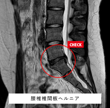 腰下肢痛、レントゲンで異常なし
