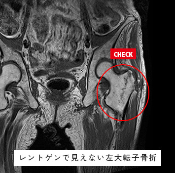 転倒後の股関節痛、レントゲンで異常なし