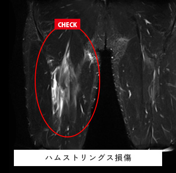 スポーツ中に受傷し痛みが続く、レントゲンで異常なし
