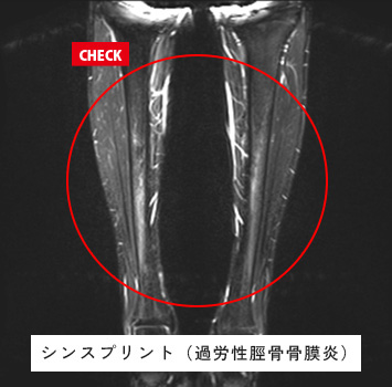 毎日ランニングしており両下腿に痛みあり、レントゲンで異常なし