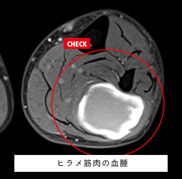 左下腿を強くぶつけ、その後腫れてきた
