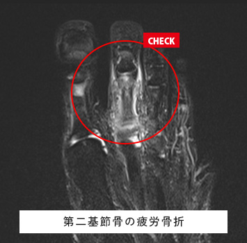 最近ランニングを始めたところ痛みが続く、レントゲンで異常なし