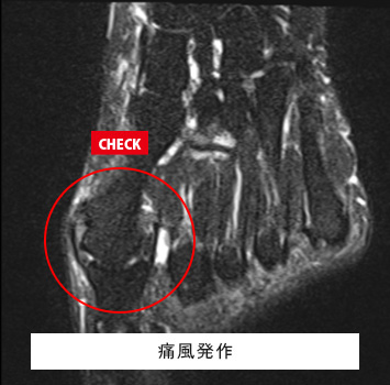 足の親指の付け根の腫れと痛み